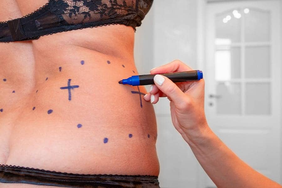 lipoaspiration avant apres docteur henri derhy chirurgien esthetique specialiste chirurgie plastique reconstructrice paris