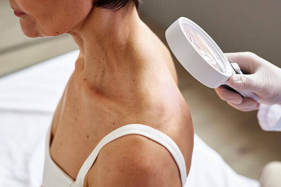 cancer de la peau dr henri derhy chirurgien esthetique specialiste chirurgie plastique reconstructrice paris