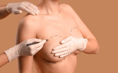 Lipofilling mammaire ou prothèses : comment choisir la meilleure option ?