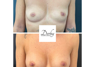 augmentation mammaire par prothèses dr henri derhy paris chirurgie esthetique