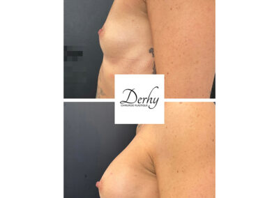 augmentation mammaire par prothèses dr henri derhy paris chirurgie esthetique profil poitrine