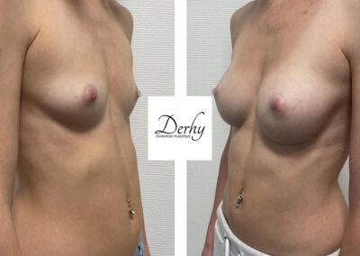 augmentation mammaire par prothèses dr henri derhy paris chirurgie esthetique seins poitrine