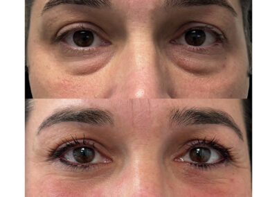 blepharoplastie inferieure dr henri derhy chirurgie esthetique