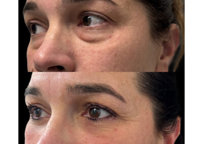 blepharoplastie inferieure dr henri derhy chirurgie esthétique visage