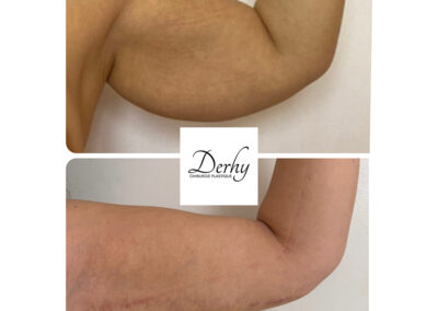 brachioplastie dr henri derhy