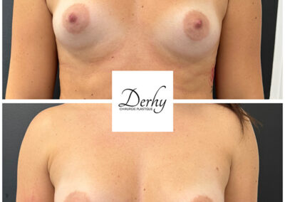 dr henri derhy augmentation mammaire lipofilling paris