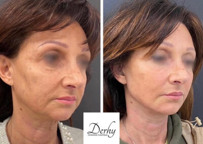 lifting dr henri derhy