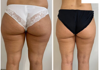 liposuccion dr henri derhy cuisses