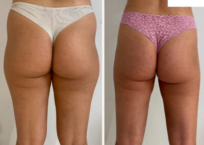 liposuccion dr henri derhy fesses