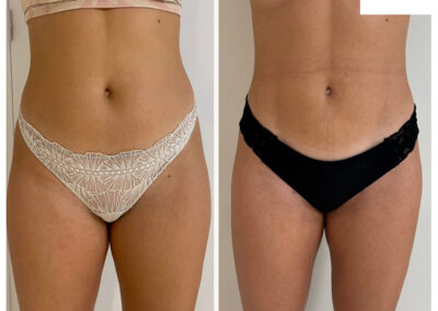 liposuccion dr henri derhy ventre