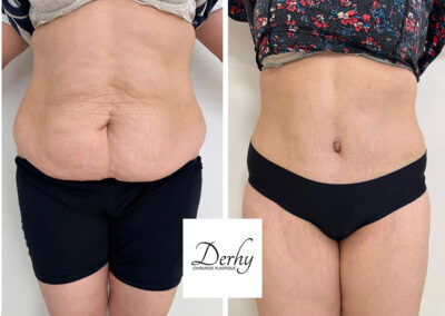 plastie abdominale dr henri derhy