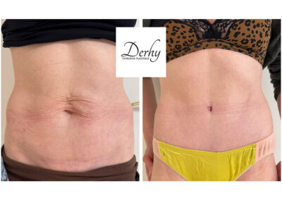 plastie abdominale dr henri derhy ventre