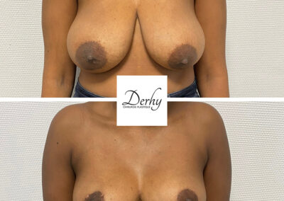 reduction mammaire dr henri derhy chirurgie esthetique paris