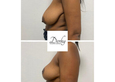 reduction mammaire dr henri derhy chirurgie esthetique paris profil poitrine