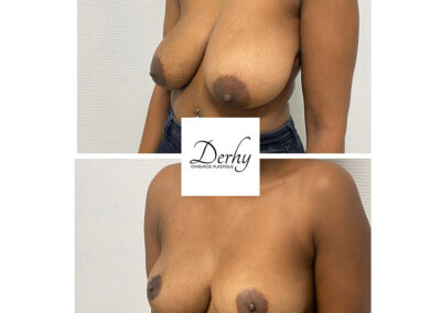 reduction mammaire dr henri derhy chirurgie esthetique paris seins