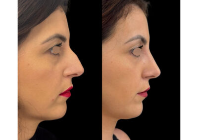 rhinoplastie dr henri derhy