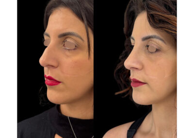 rhinoplastie dr henri derhy chirurgie esthetique