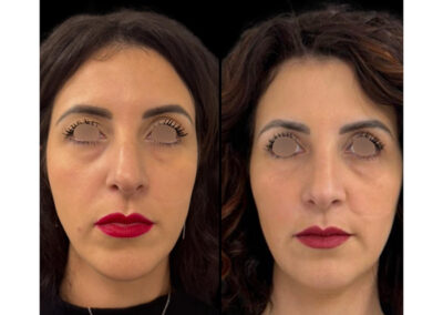 rhinoplastie dr henri derhy chirurgie esthetique paris