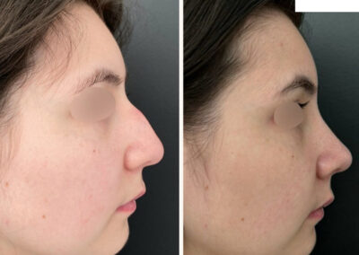 rhinoplastie dr henri derhy chirurgie esthetique paris visage