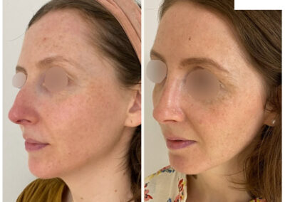 rhinoplastie dr henri derhy nez chirurgie