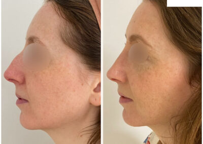 rhinoplastie dr henri derhy paris chirurgien esthetique